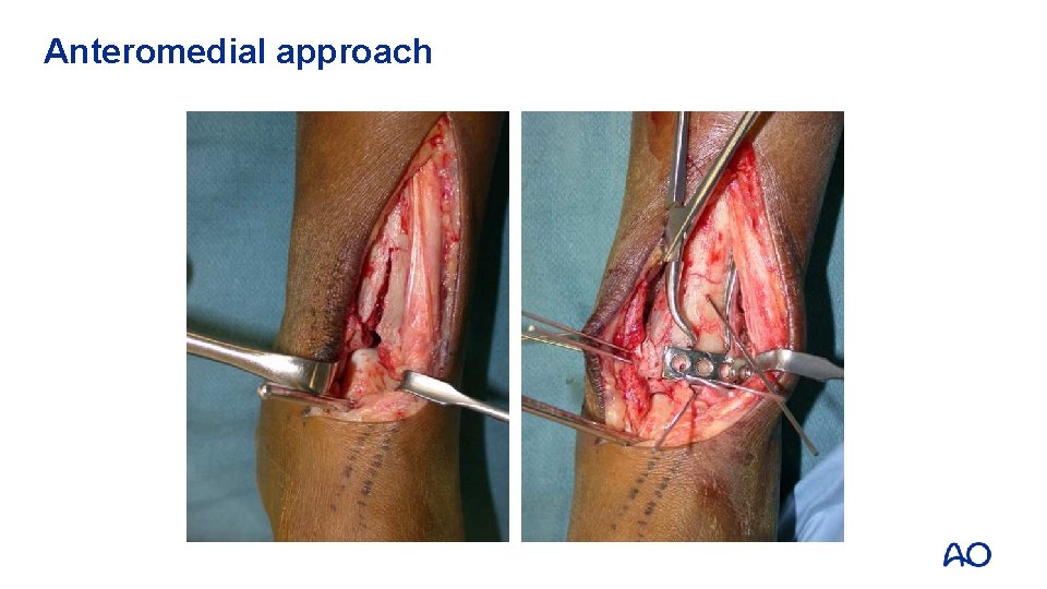 Anteromedial approach 