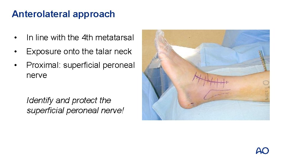 Anterolateral approach • In line with the 4 th metatarsal • Exposure onto the