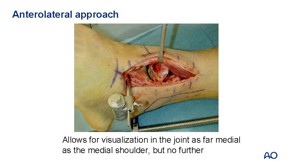 Anterolateral approach Allows for visualization in the joint as far medial as the medial