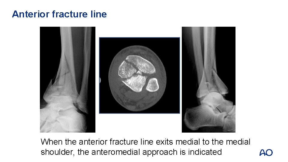 Anterior fracture line When the anterior fracture line exits medial to the medial shoulder,