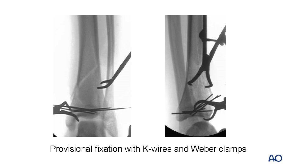 Provisional fixation with K-wires and Weber clamps 