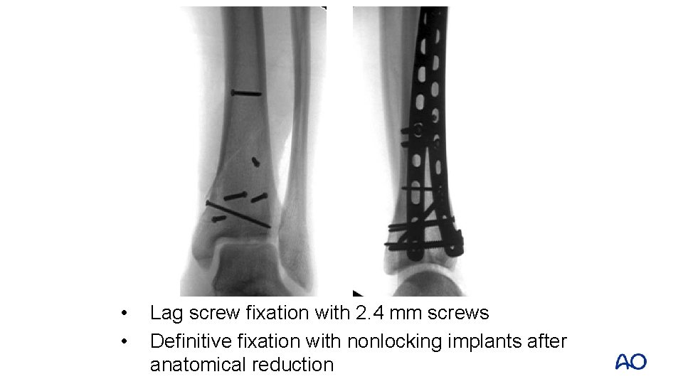  • • Lag screw fixation with 2. 4 mm screws Definitive fixation with