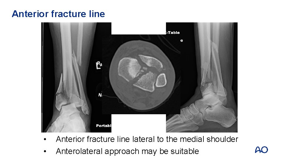 Anterior fracture line • • Anterior fracture line lateral to the medial shoulder Anterolateral