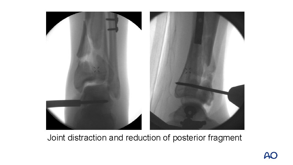 Joint distraction and reduction of posterior fragment 