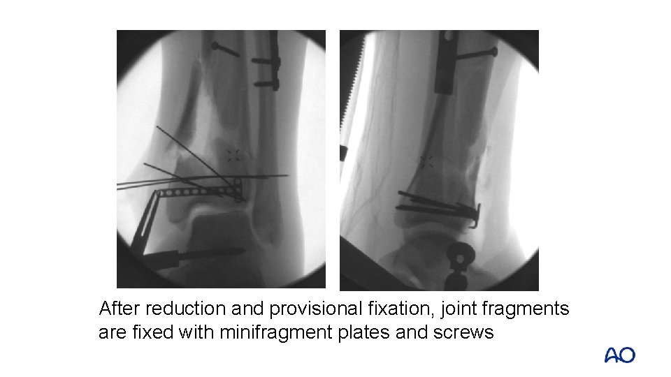 After reduction and provisional fixation, joint fragments are fixed with minifragment plates and screws