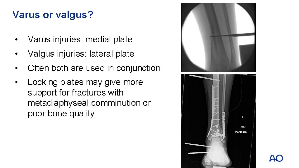 Varus or valgus? • Varus injuries: medial plate • Valgus injuries: lateral plate •