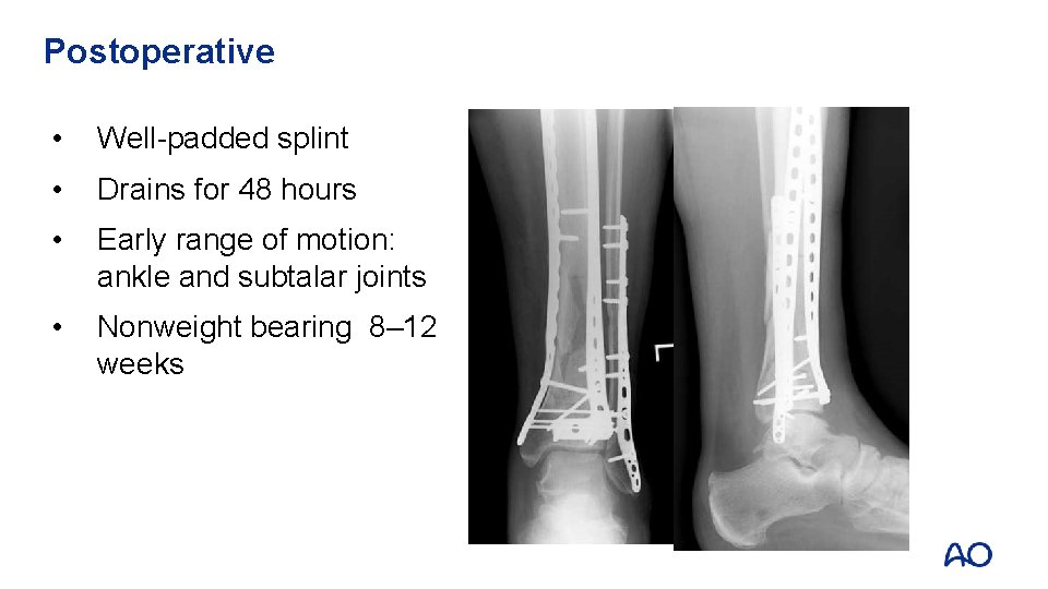 Postoperative • Well-padded splint • Drains for 48 hours • Early range of motion: