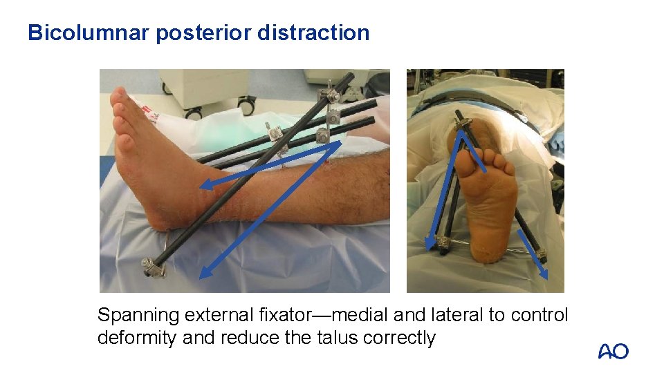 Bicolumnar posterior distraction Spanning external fixator—medial and lateral to control deformity and reduce the