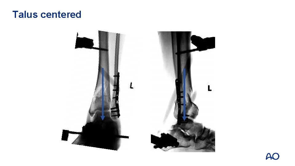 Talus centered 