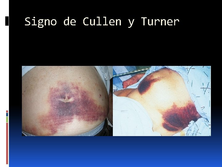 Signo de Cullen y Turner 