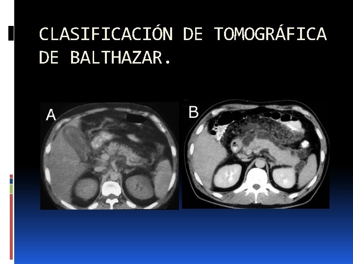 CLASIFICACIÓN DE TOMOGRÁFICA DE BALTHAZAR. 