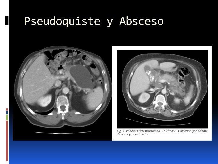 Pseudoquiste y Absceso 