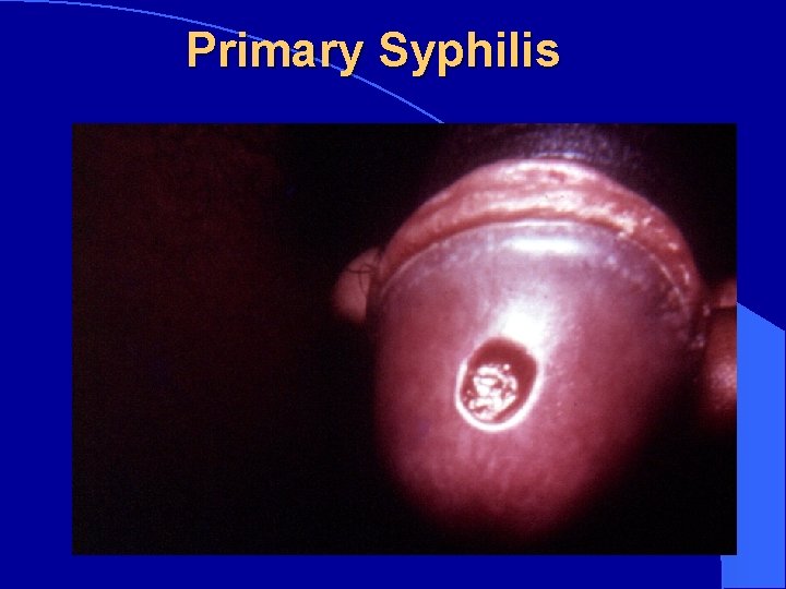 Primary Syphilis 