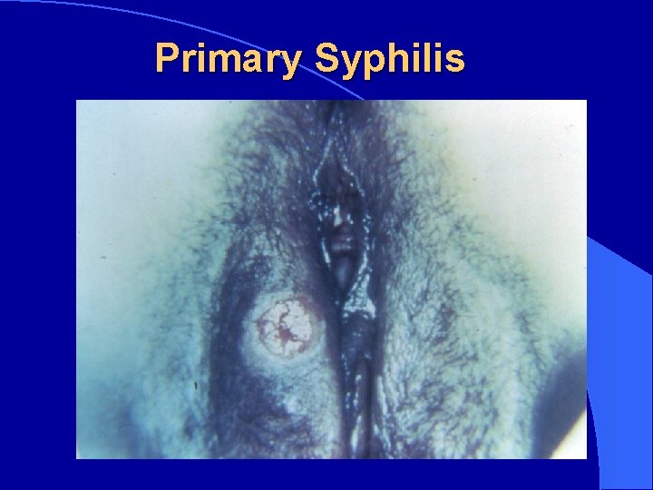 Primary Syphilis 