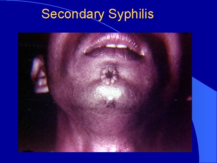 Secondary Syphilis 