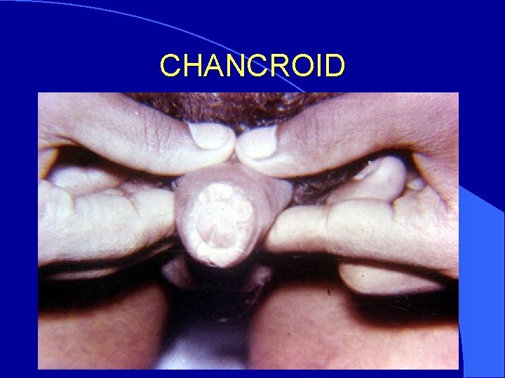 CHANCROID 