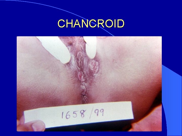 CHANCROID 