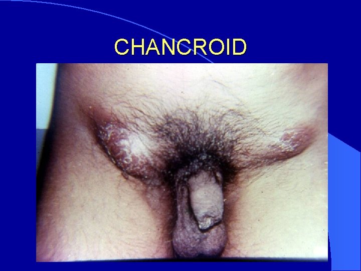 CHANCROID 