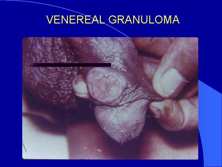 VENEREAL GRANULOMA 