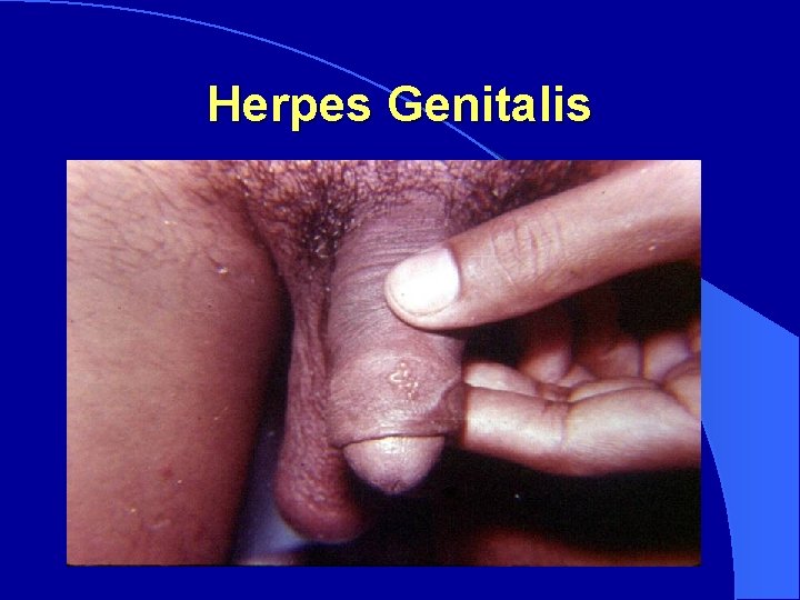 Herpes Genitalis 