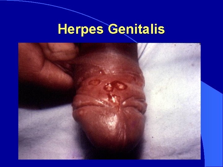 Herpes Genitalis 
