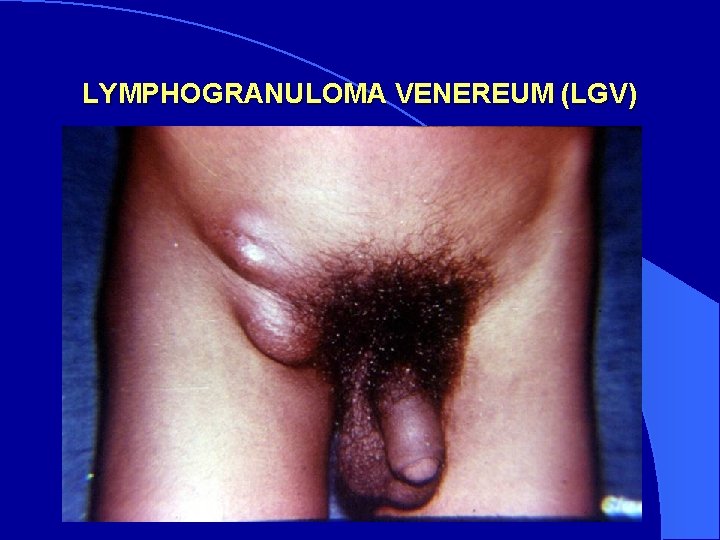 LYMPHOGRANULOMA VENEREUM (LGV) 