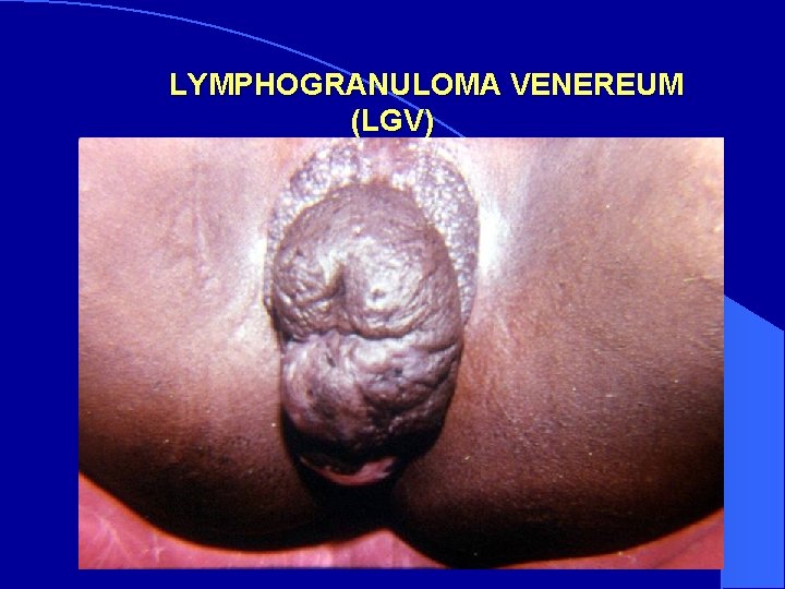 LYMPHOGRANULOMA VENEREUM (LGV) 