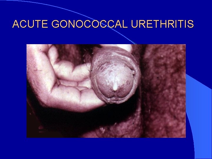 ACUTE GONOCOCCAL URETHRITIS 