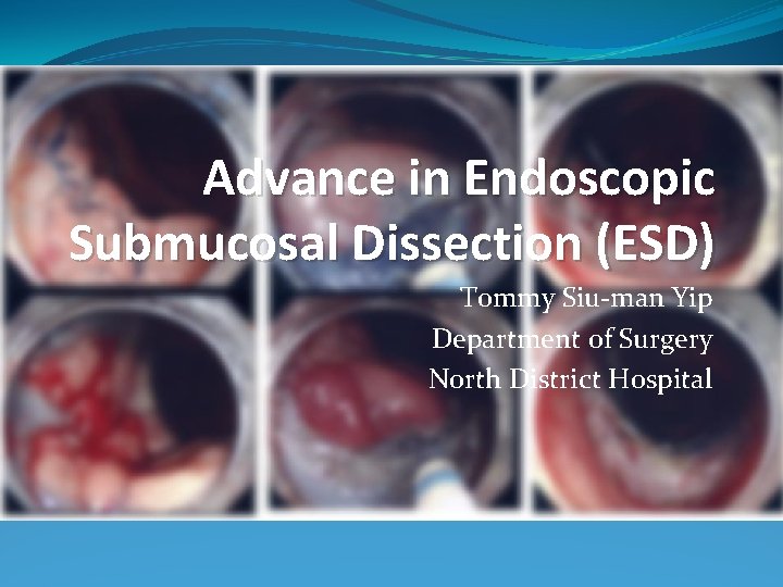 Advance in Endoscopic Submucosal Dissection (ESD) Tommy Siu-man Yip Department of Surgery North District