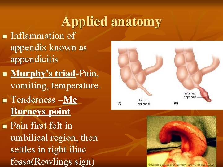 Applied anatomy n n Inflammation of appendix known as appendicitis Murphy's triad-Pain, vomiting, temperature.