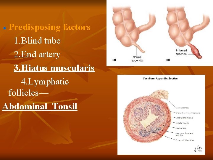 Predisposing factors 1. Blind tube 2. End artery 3. Hiatus muscularis 4. Lymphatic follicles—