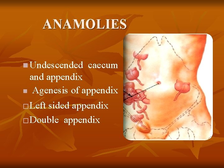 ANAMOLIES n Undescended caecum and appendix n Agenesis of appendix Left sided appendix �