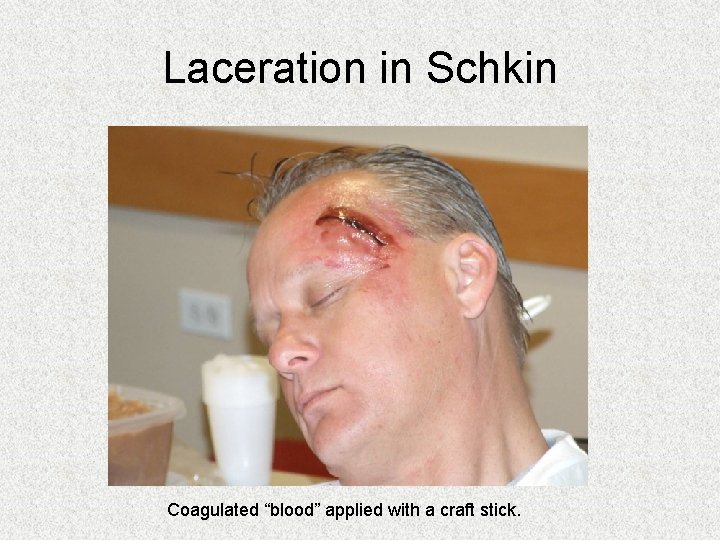 Laceration in Schkin Coagulated “blood” applied with a craft stick. Laceration in Schkin Coagulated “blood” applied with a craft stick.