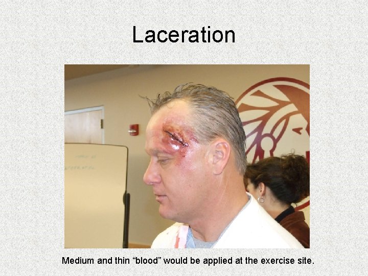Laceration Medium and thin “blood” would be applied at the exercise site. Laceration Medium and thin “blood” would be applied at the exercise site.