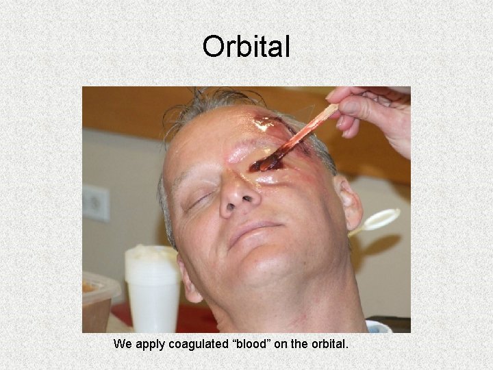 Orbital We apply coagulated “blood” on the orbital. Orbital We apply coagulated “blood” on the orbital.