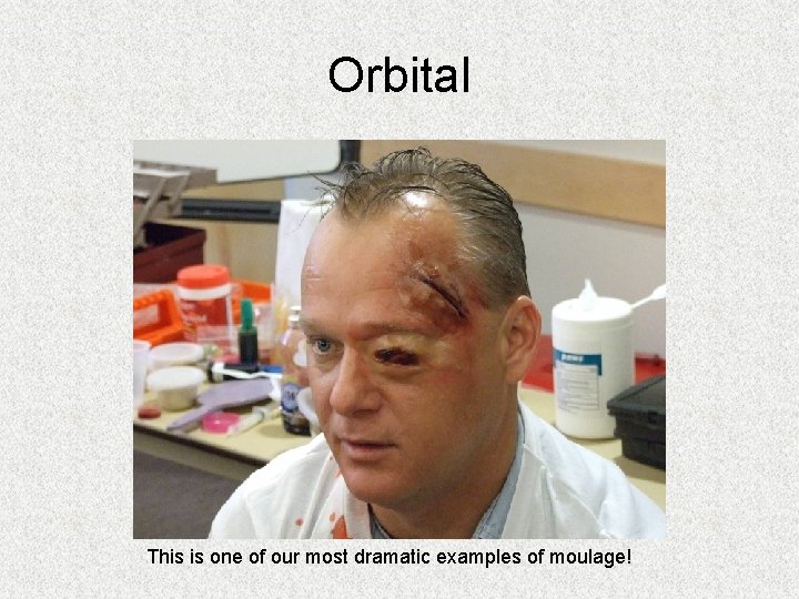 Orbital This is one of our most dramatic examples of moulage! Orbital This is one of our most dramatic examples of moulage!