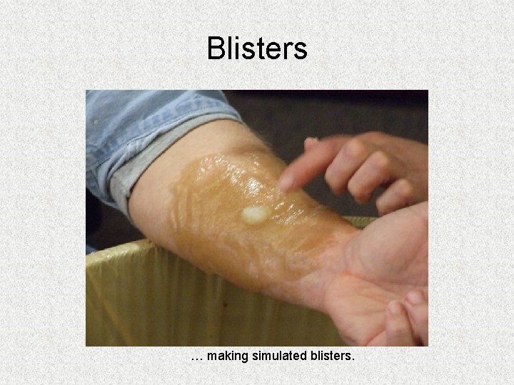 Blisters … making simulated blisters. Blisters … making simulated blisters.