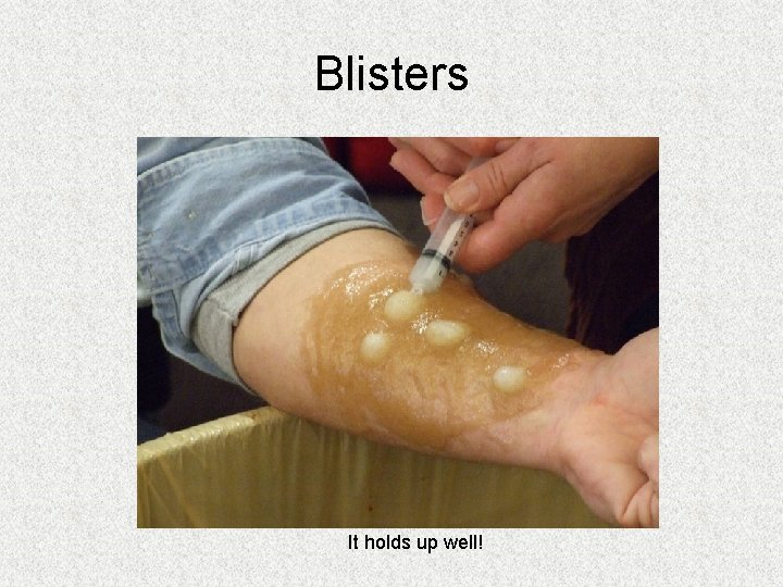 Blisters It holds up well! Blisters It holds up well!