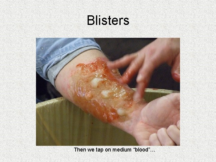 Blisters Then we tap on medium “blood”… Blisters Then we tap on medium “blood”…