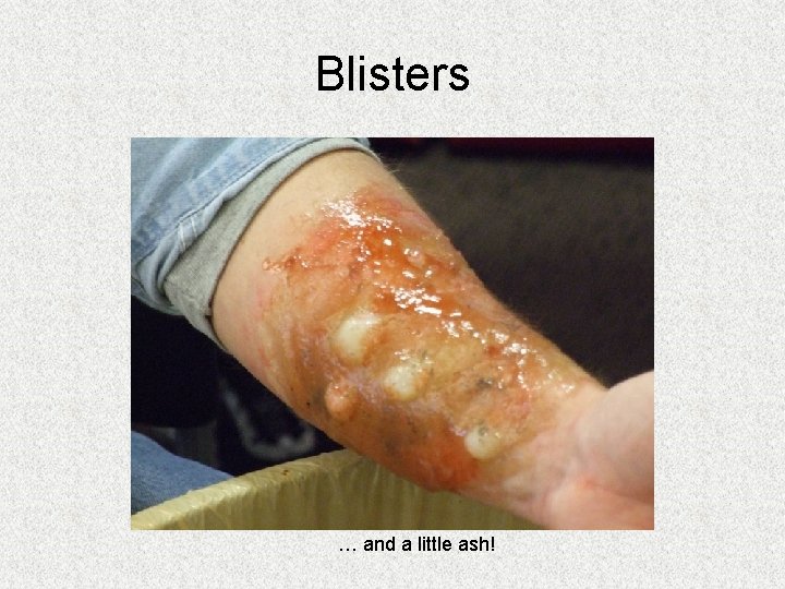 Blisters … and a little ash! Blisters … and a little ash!