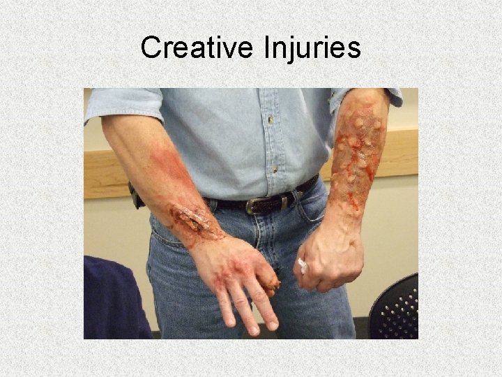 Creative Injuries Creative Injuries
