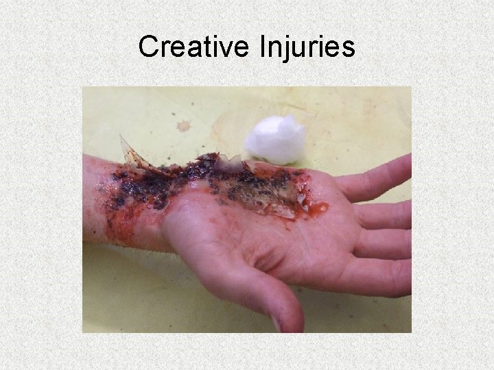 Creative Injuries Creative Injuries