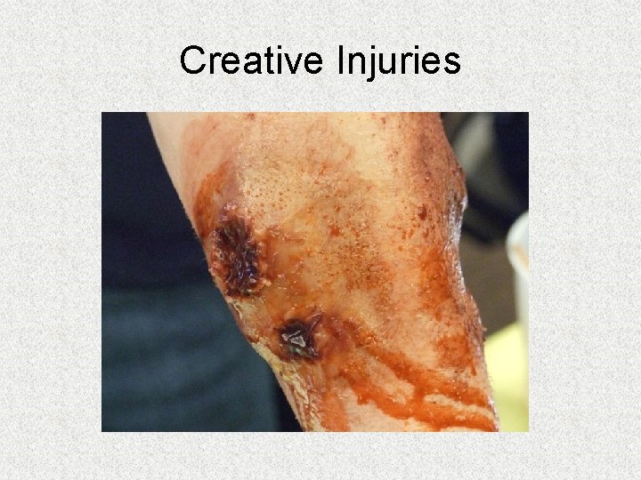Creative Injuries Creative Injuries