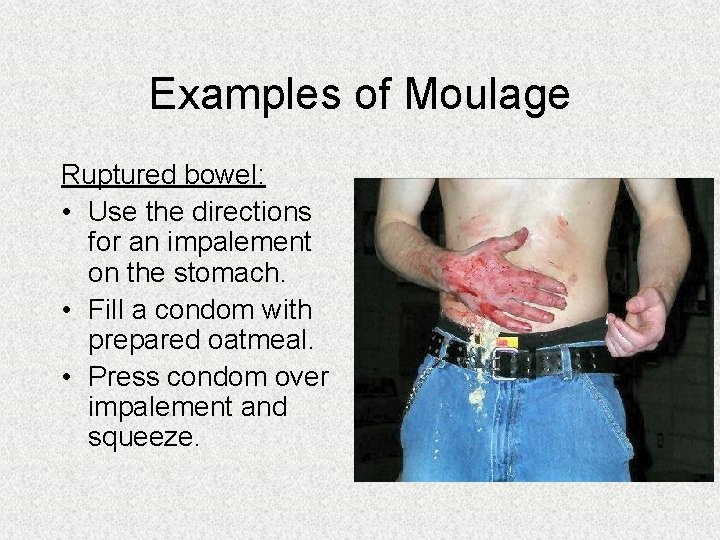 Examples of Moulage Ruptured bowel: • Use the directions for an impalement on the Examples of Moulage Ruptured bowel: • Use the directions for an impalement on the