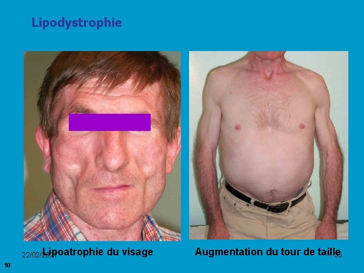 Lipodystrophie Lipoatrophie du visage 22/02/2021 10 Augmentation du tour de taille 35 