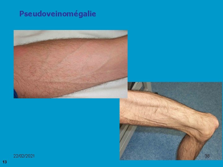 Pseudoveinomégalie 22/02/2021 13 38 