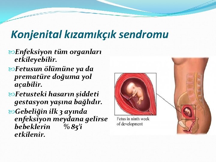 Konjenital kızamıkçık sendromu Enfeksiyon tüm organları etkileyebilir. Fetusun ölümüne ya da prematüre doğuma yol
