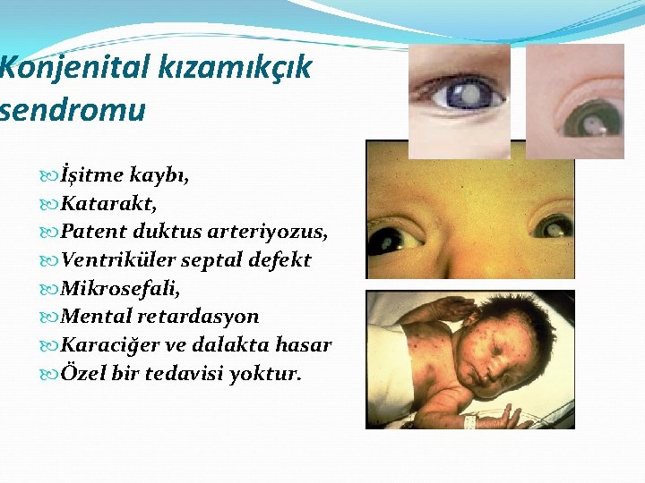 Konjenital kızamıkçık sendromu İşitme kaybı, Katarakt, Patent duktus arteriyozus, Ventriküler septal defekt Mikrosefali, Mental