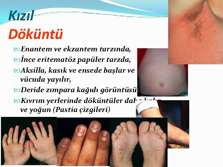 Kızıl Döküntü Enantem ve ekzantem tarzında, İnce eritematöz papüler tarzda, Aksilla, kasık ve ensede