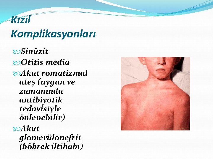 Kızıl Komplikasyonları Sinüzit Otitis media Akut romatizmal ateş (uygun ve zamanında antibiyotik tedavisiyle önlenebilir)